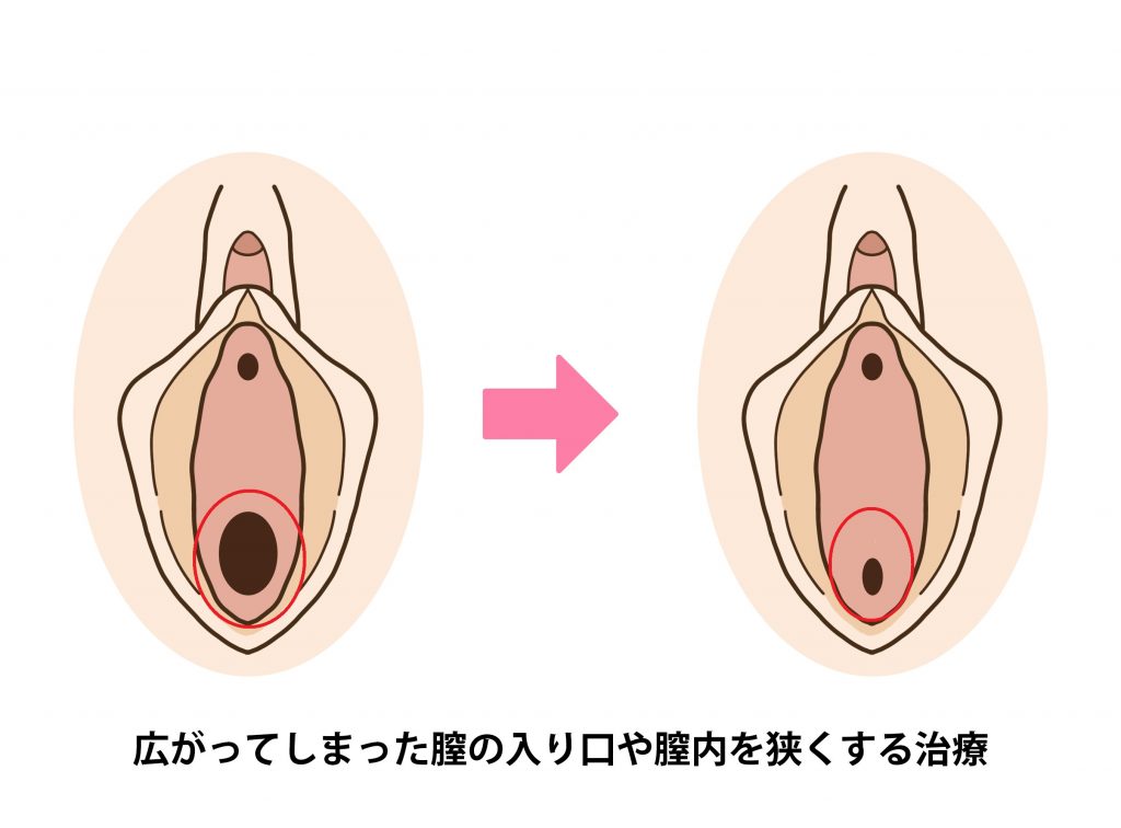 膣引き締め